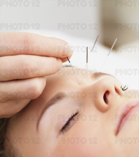 Woman receiving acupuncture. Date : 2008