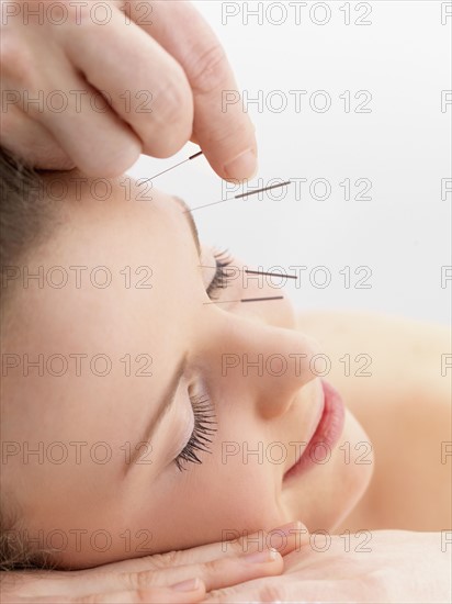 Woman receiving acupuncture. Date : 2008