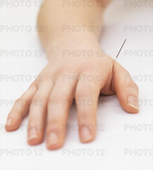 Woman receiving acupuncture. Date : 2008