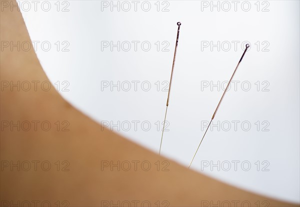 Acupuncture needles.