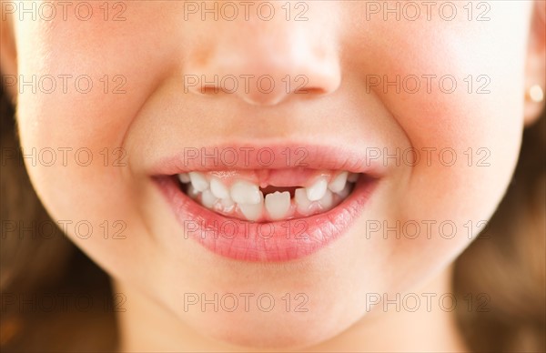 Close-up of girl's (2-3) mouth with some teeth missing. Photo : Daniel Grill