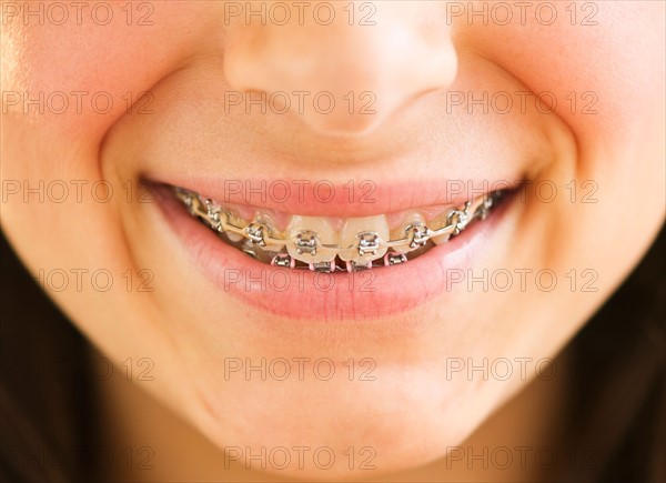 Close-up of girl's (12-13) teeth braces. Photo : Daniel Grill