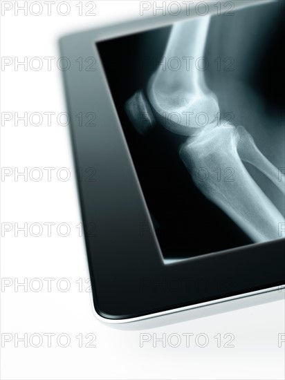 Studio shot of digital tablet with x-ray of human knee. Photo : David Arky