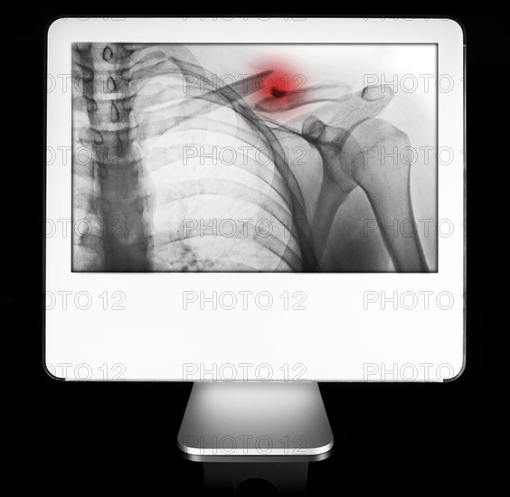 Arm fracture appearing on diagnostic monitor. 
Photo : Calysta Images