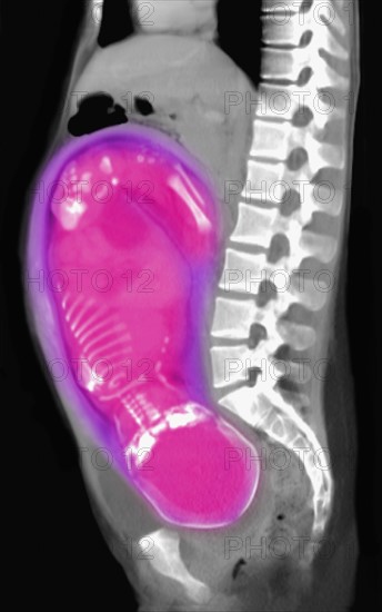 CT scan of abdomen of 25 year old pregnant woman with full term fetus. 
Photo: Calysta Images