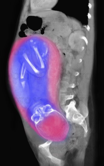 CT scan of abdomen of 25 year old pregnant woman with full term fetus. 
Photo : Calysta Images