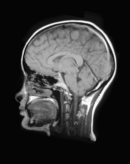 MRI Scan of human head. 
Photo : Calysta Images