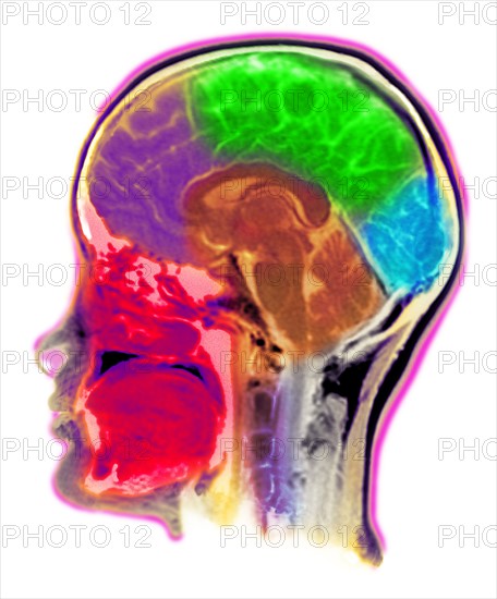 MRI Scan of human head. 
Photo : Calysta Images