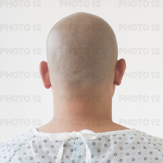Back view of patient with shaved head.