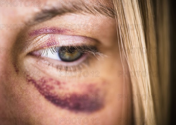 Portrait of woman with black eye. Photo : Jamie Grill