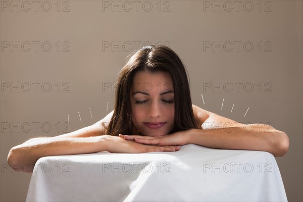 Woman laying on stomach with acupuncture needles in her shoulders. Photo : Mike Kemp