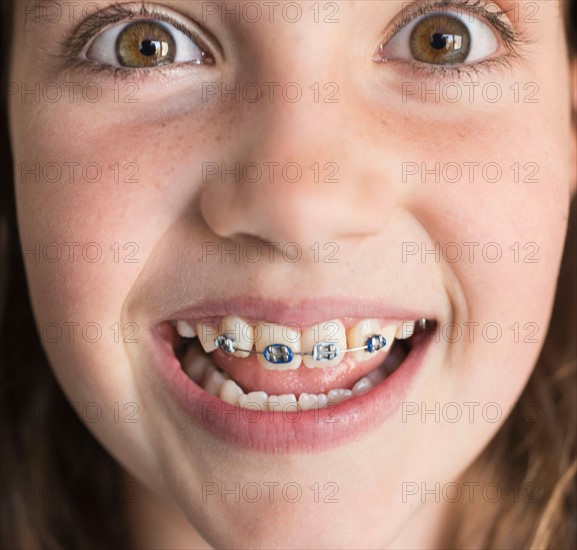 Girl (8-9) showing braces.