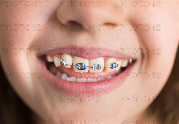 Close up of girl's (8-9) mouth with braces.