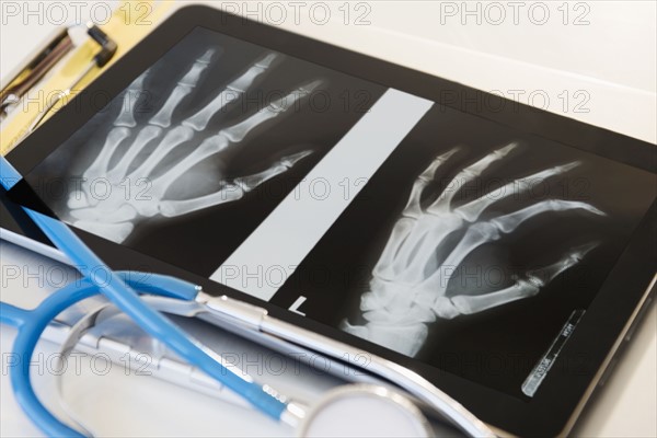 X-ray of human hand on digital tablet