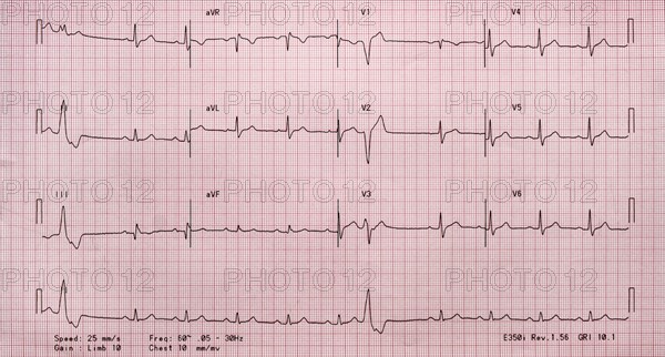 Electrocardiogram on red graph paper