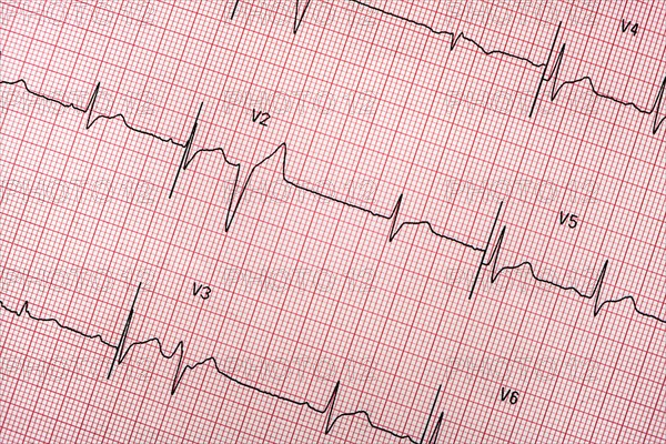 Electrocardiogram on red graph paper