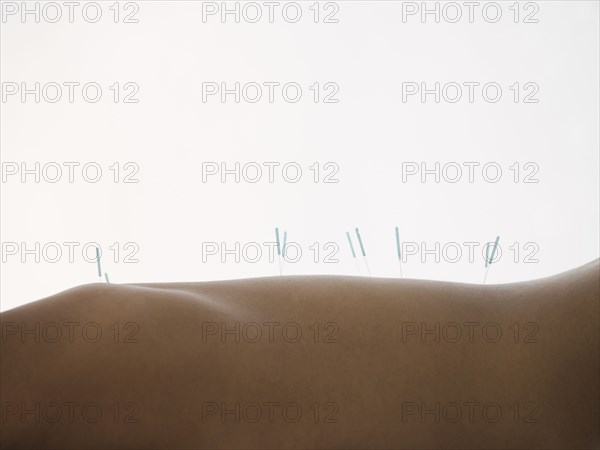 Close up of woman with acupuncture needles in back