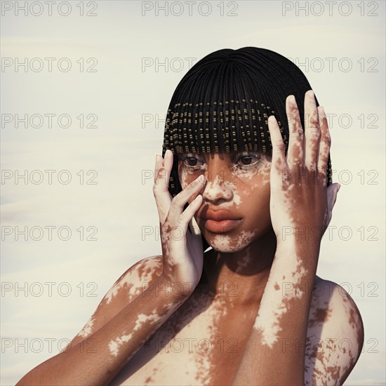 Woman with vitiligo