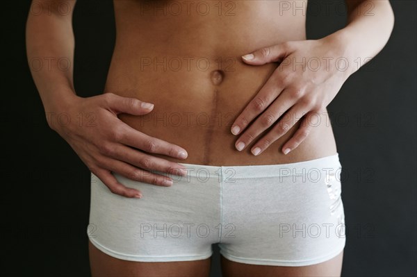 Close up of Hispanic woman with surgical scar