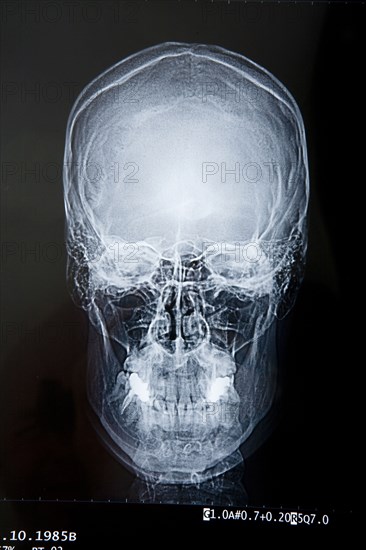 Close up of x-ray of skull