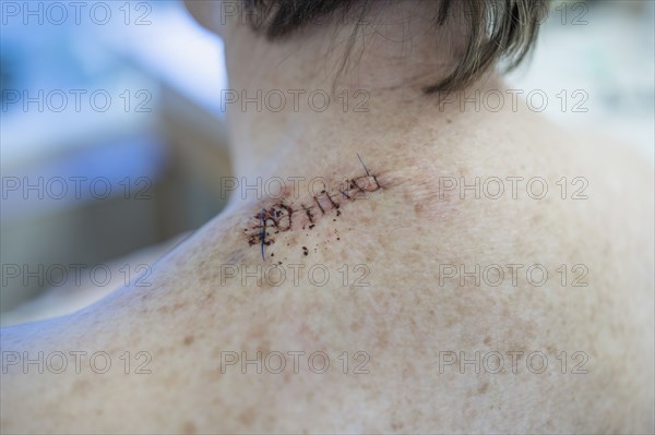 Medical stitches in woman's back after surgery