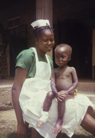 Midwife with a malnourished child. Portrait of a uniformed midwife from a Church of Nigeria hospital, seated outdoors with a young child on her lap. An original caption suggests the child is suffering from malnutrition: the discoloured skin and bandaged foot are possibly symptoms of dermatitis. Nigeria, circa 1970. Nigeria, Western Africa, Africa.
