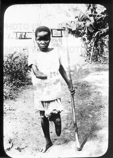 Congo Free State mutilations. Portrait of a mutilated boy whose hand and foot have been amputated: a victim of atrocities committed under King Leopold II's regime. Congo Free State (Democratic Republic of Congo), circa 1905. Congo, Democratic Republic of, Central Africa, Africa.