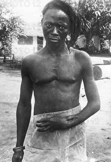Congo Free State mutilations. Portrait of a young Congolese man identified as 'Lomboto of Bolumboloko'. His hand and wrist have been left deformed after he was shot by soldiers under King Leopold II's terror regime. Congo Free State (Democratic Republic of Congo), circa 1905. Congo, Democratic Republic of, Central Africa, Africa.