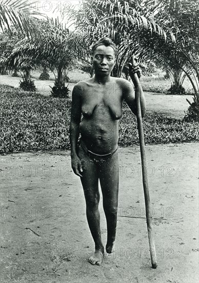 Congo Free State mutilations. Portrait of a mutilated woman whose foot has been amputated: a victim of atrocities committed under King Leopold II's terror regime. Congo Free State (Democratic Republic of Congo), circa 1905. Congo, Democratic Republic of, Central Africa, Africa.