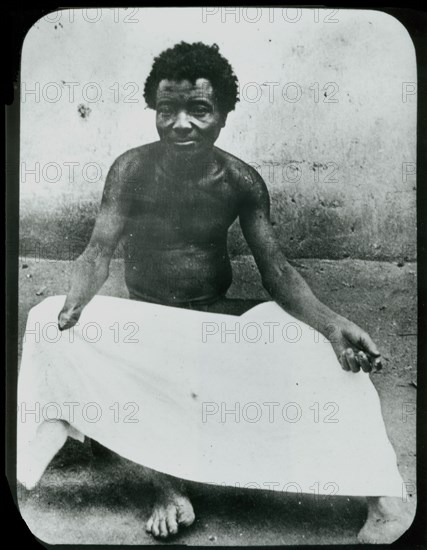Congo Free State mutilations. Portrait of a mutilated man whose hand has been amputated: a victim of atrocities committed under King Leopold II's terror regime. Congo Free State (Democratic Republic of Congo), circa 1905. Congo, Democratic Republic of, Central Africa, Africa.