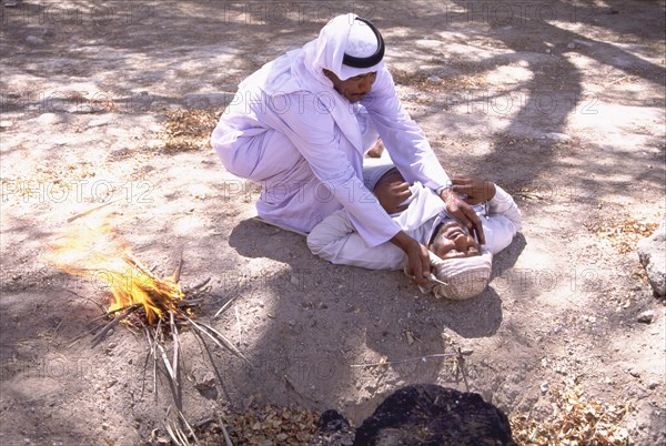 "Burning" or cauterizing with hot irons