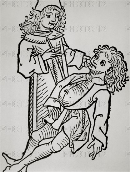 History of medicine. Modern Age. Belly infaldo. Cirrhosis. Woodcut. Hortus Sanitatis. 14th century.