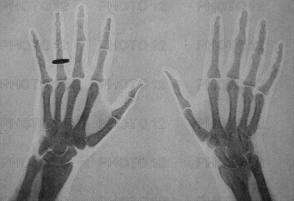 one of the first X-ray images of a human hand with ring