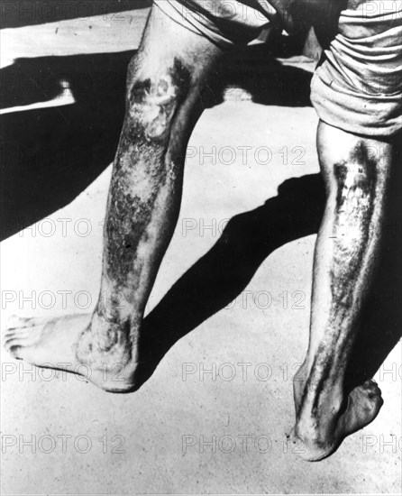 Effects of Atomic Heat and Radiation on Humans, Japan ca. 1945