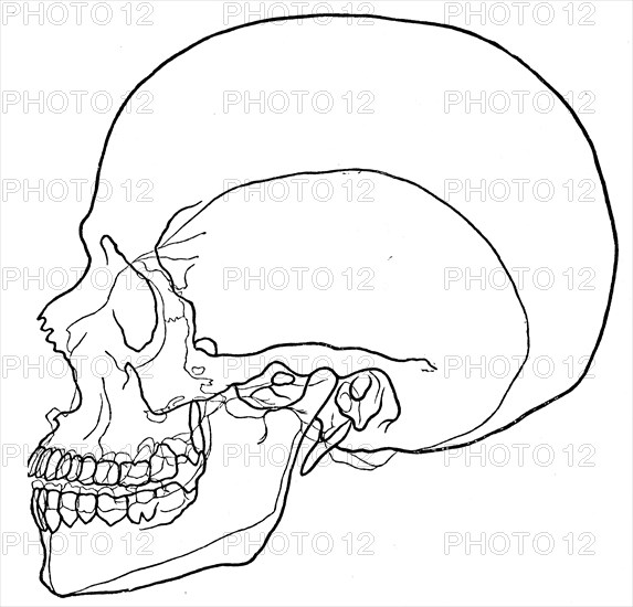 Microcephalic skull.