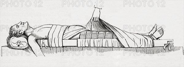 The application of Liston's Long Splint.