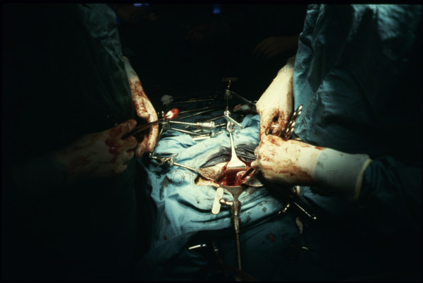 Operation with 'Octopus' assistant device 1980
