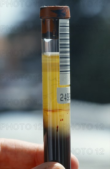 HEALTH, Blood, Serum in test tube