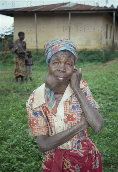 ANGOLA, Health, Woman suffering from goitre iodine deficiency