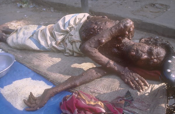 BANGLADESH, Dhaka, Elderly man suffering from a medical condition called Neurofibromatosis resulting in his whole body and face being covered in lumps lying in the street begging