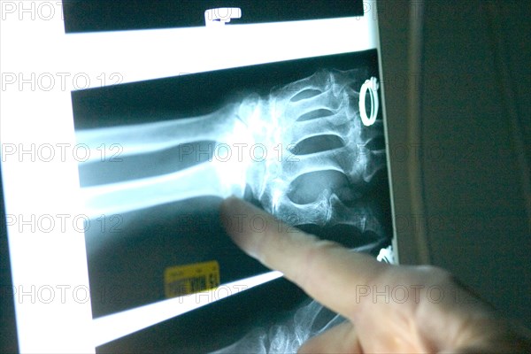 USA, Minnesota, Plymouth, Emergency room doctor pointing at x-ray of broken wrist of 90 year old woman.