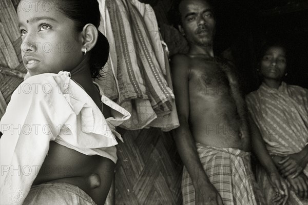 INDIA, West Bengal, Mal, Parents display a growth on their daughter's spine in a West Bengal village