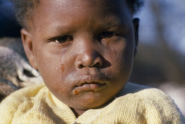 SOUTH AFRICA, Gauteng, Soweto, "Portrait of young child with dirty, tear stained face and sores around mouth."