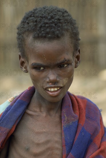 SOMALIA, Baidoa, Severely malnourished child at CONCERN feeding centre.