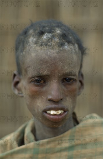SOMALIA, Baidoa, Severely malnourished boy at CONCERN feeding centre.