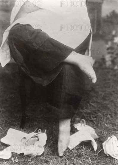 Chine, femme aux petits pieds bandés